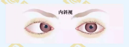 什么是調(diào)節(jié)性內(nèi)斜視？