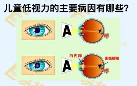 兒童低視力主要病因有哪些？