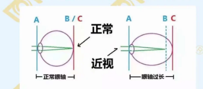 哪個(gè)年齡近視度數(shù)最容易增長(zhǎng)？