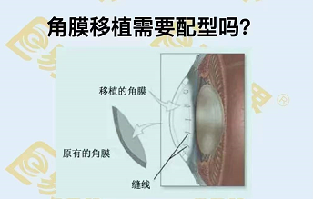 角膜移植需要配型嗎？