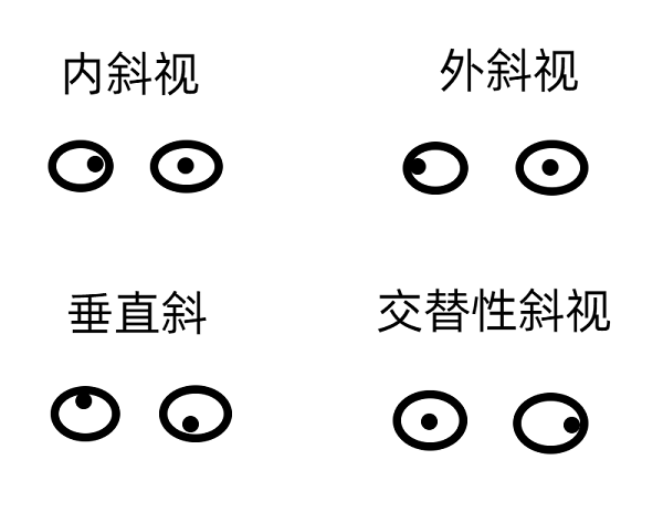 斜視早期的癥狀有哪些？